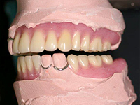 臼歯部は3mm程度高く採得