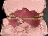 インサイザルピンをはずすと前歯部は早期接触して