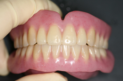 本ケースは下顎前歯部の排列位置がニュートラルゾーン内にあると判断し、 排列位置の変更はしなかった。