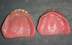 左は旧義歯で前歯が突出している。