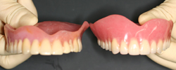 左の旧義歯に比べ新義歯は、その咬合高径がかなり高くなっている。