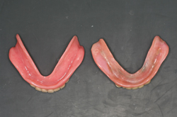左が新義歯の粘膜面観