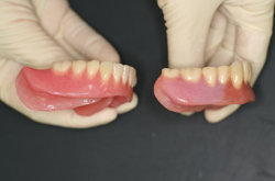 左が新義歯の右側面観で、顎舌骨筋側が旧義歯に比較して長い