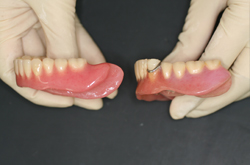 左が新義歯の左側面観で、右側同様旧義歯に比較して長い