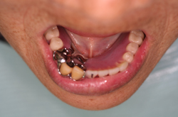 下顎義歯前歯唇面に舌小帯付着部と同位置をマジックにてマーク。