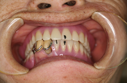 上下義歯を咬合していただく。下顎マジックマークの左側（患者さんとしては右側）は、舌小帯付着部と同位置。