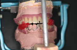 いわゆる軟化パラフィンワックス臼歯部咬合法のBT WAXで咬合器にマウントする。