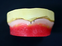 (A)正中より遠心5mm床縁を測定点として、 上顎前歯部の高径を決める。