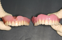 左が旧義歯、右が新義歯
