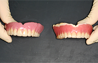 左が新義歯、右が旧義歯
