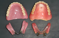 左が新義歯、右が旧義歯
