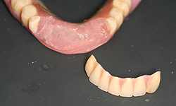 下顎前歯をはずし、左右の4は近心1/2を削り取る