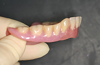 下顎前歯が上顎歯列にひきずられ、かなり前方位に排列されている