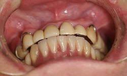 上顎3-3Bridgeと下顎総義歯の関係