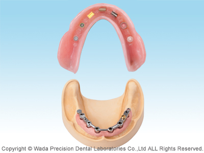 インプラントオーバーデンチャー - 【公式】和田精密歯研株式会社