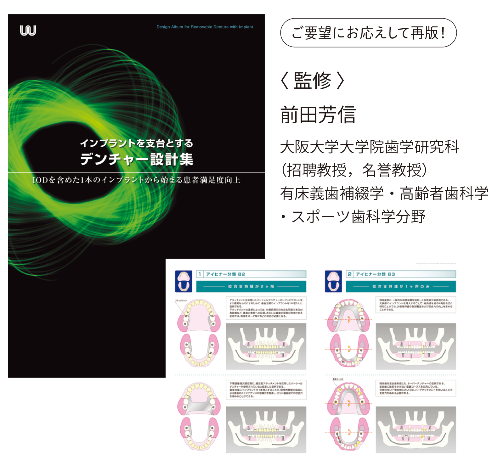 インプラントを支台とするデンチャー設計集