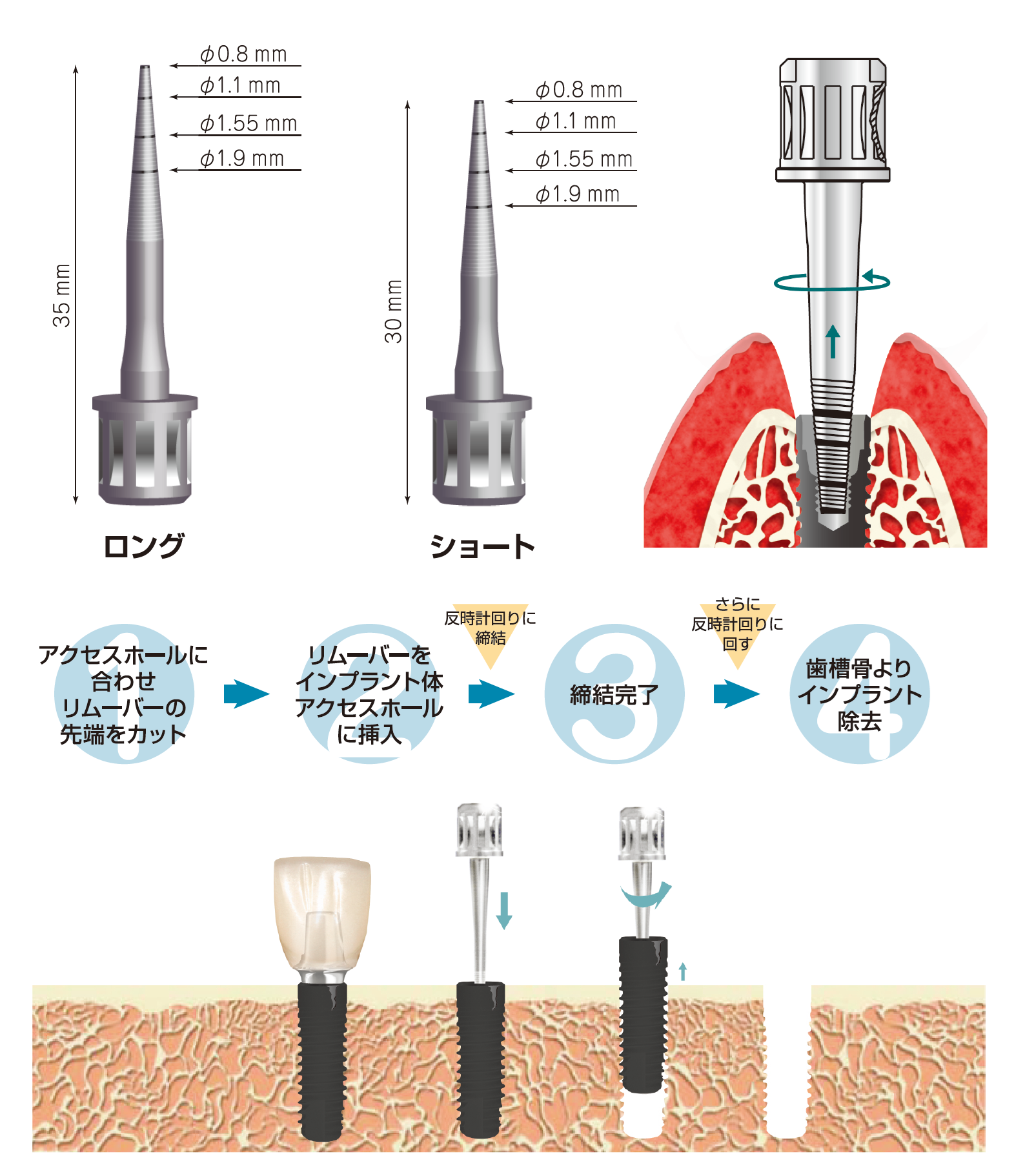 インプラントリムーバー